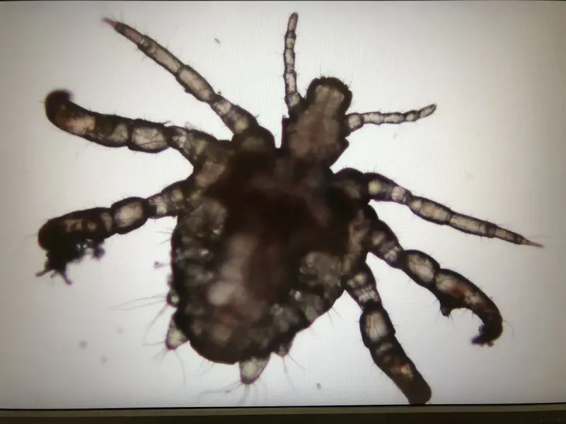 Hình ảnh trứng chấy (nit) bám trên tóc