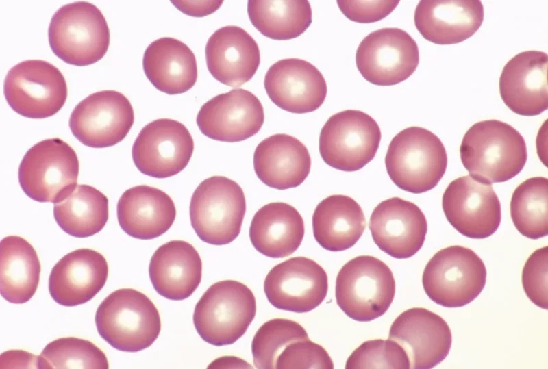 Tế bào máu bị bệnh thay đổi hình dạng